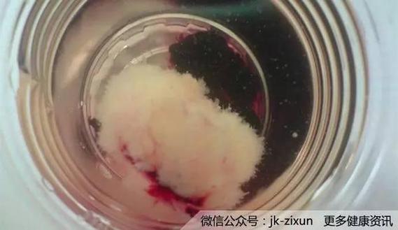 药流第三天吃米索前列醇后多久能掉下来？全过程介绍
